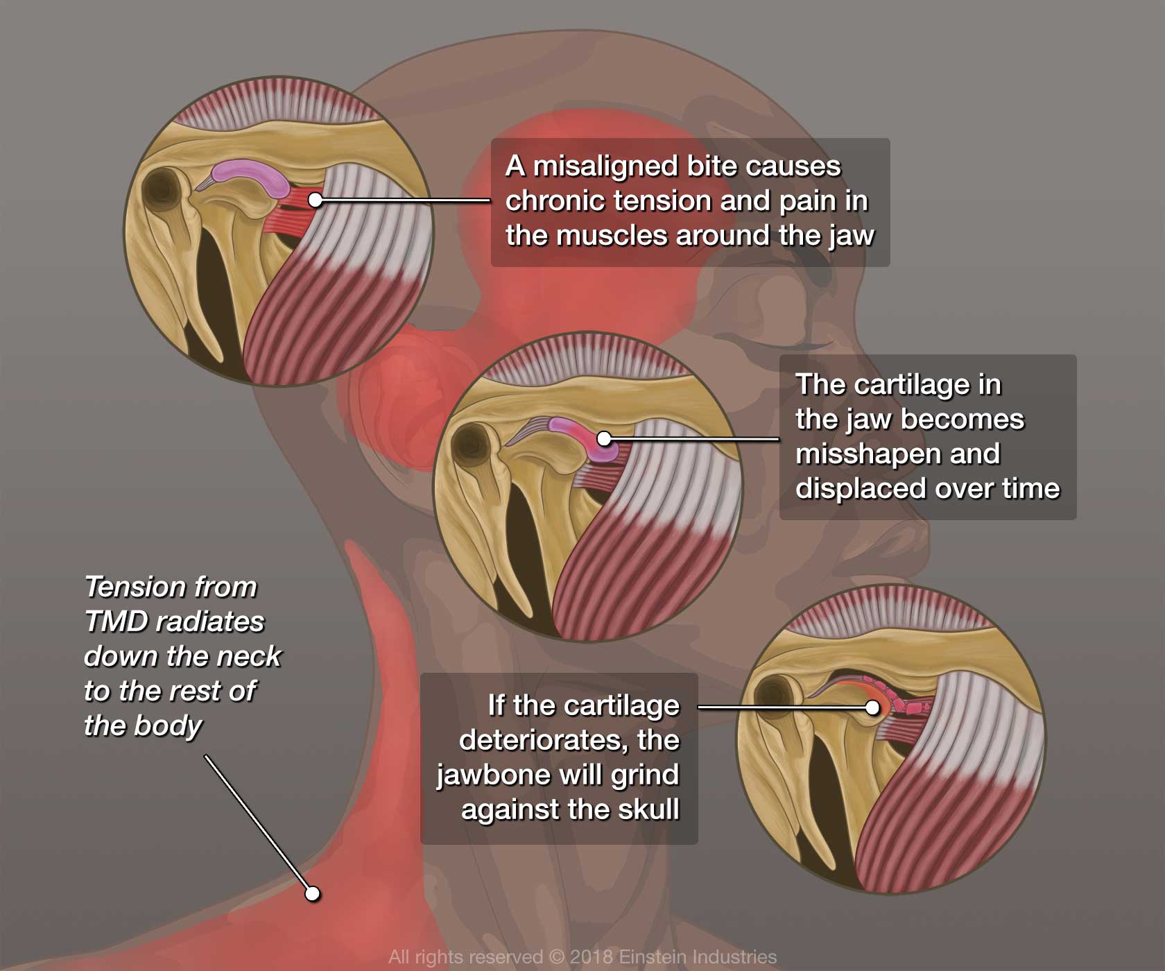 An illustration of how TMJ disorder affects the body